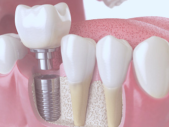 Bone Grafting for Dental Implants: What Is It and How Does It Work?